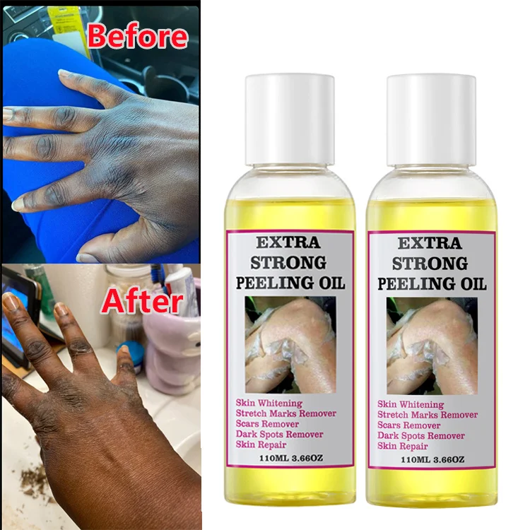 Private Label Extra Strong Peeling Oil Scar Remove Stretch Marks Whitening Yellow Peeling Oil