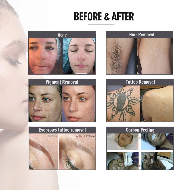 Аппарат для удаления волос ipl 3 в 1 opt elight аппарат лазерной эпиляции pl beauty nd yag новая технология