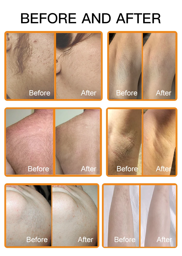 Newest  Apolomed Laser Removal Hair 808nm Diode Laser Hair Removal for Commercial and Home Use supplier