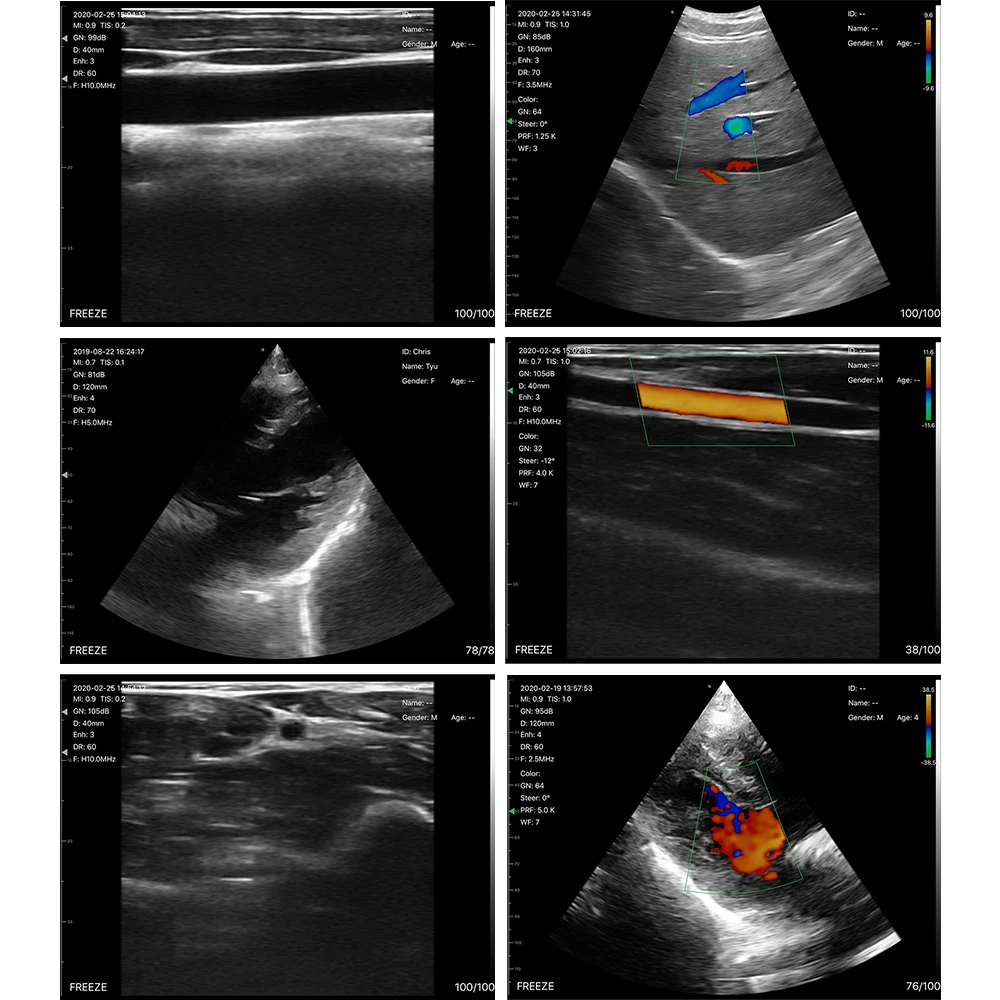 Suresult Wireless Phased Array Ultrasound System for Medical Use