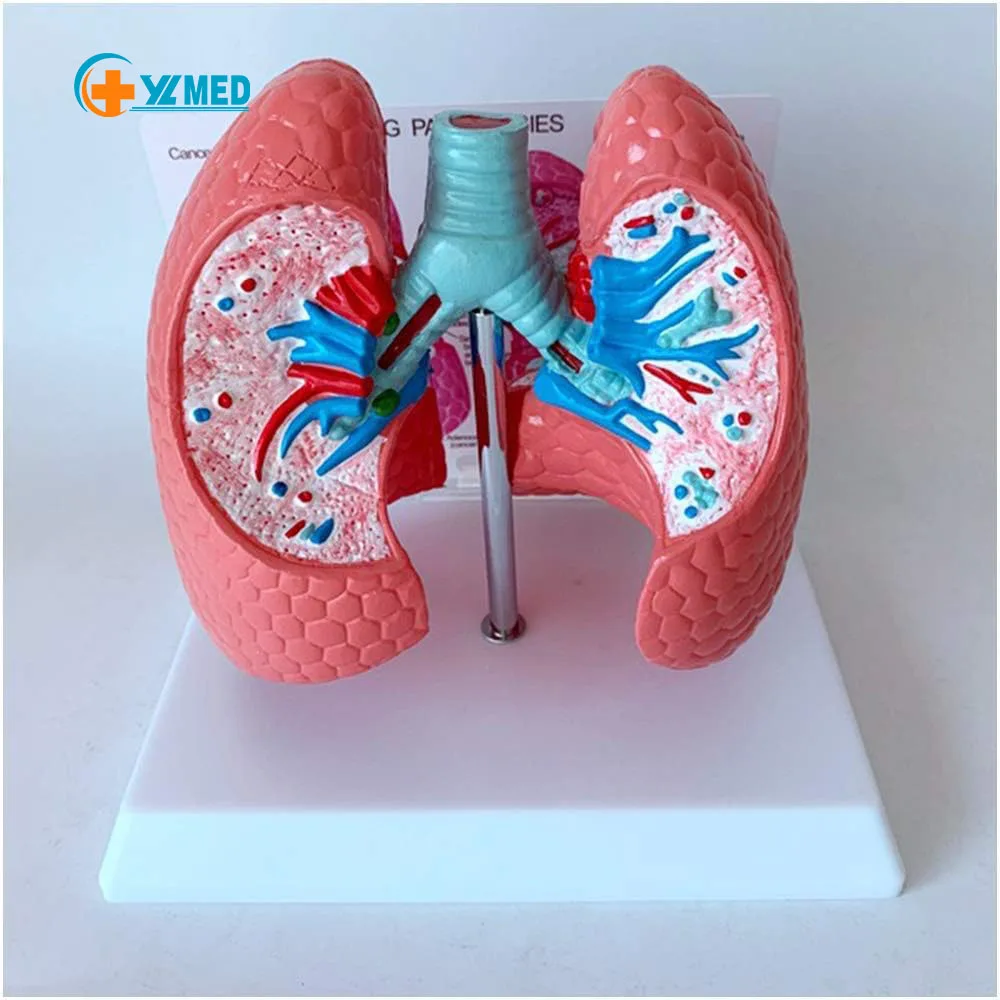 Medical Science Human Healthy Lung Compared With Sick Lung Contrast ...