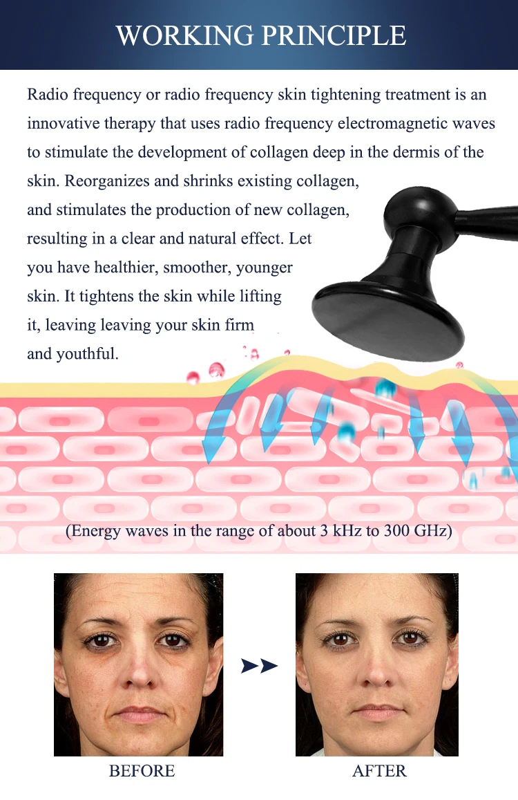 At Home Radiofrequency Skin Tightening Radio Frequency Machine Skin Tightening 0.3mhz 0.5mhz