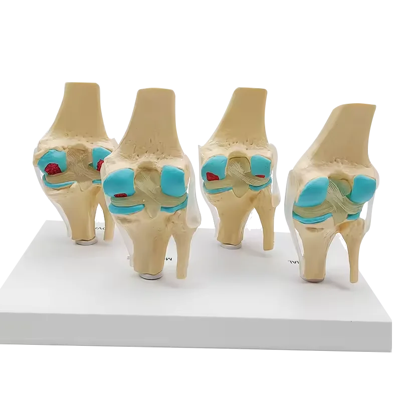 Anatomic Model of Knee Osteoarthritis 4-Stage Human Knee Joint ...