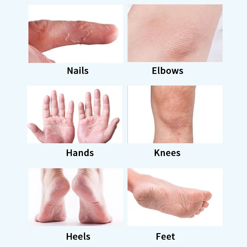 Moisturizing Rough Skin Urea Foot Care Cream for Cracked Heels Urea 40% Cream callus remover cream