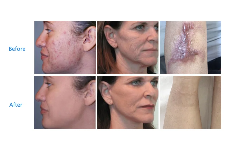 Láser Diodo Laser Menton Opiniones Depilacion Laser Menton