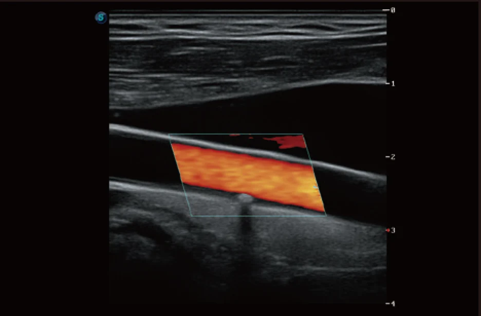 Sonoscape P20 Mobile 3D/4D Real-time Color Panoramic Doppler Trolley Ultrasound Machine supplier
