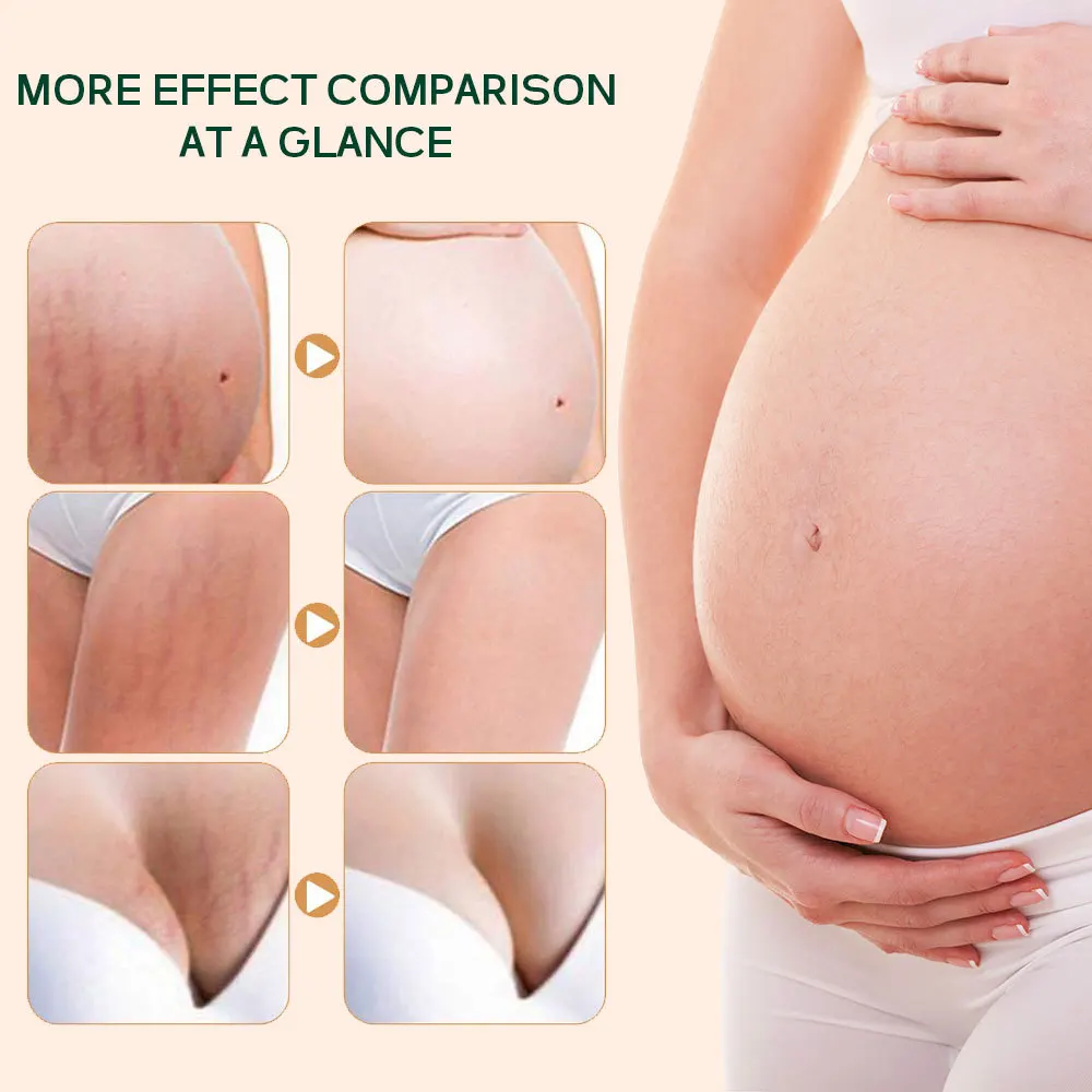 Strong Effective Stretch Mark Removal Oil Scar Remover Body Pregnancy
