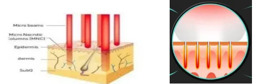 Facial Radio frequency vacuum rf Skin Tightening Rf Microneedling Machine