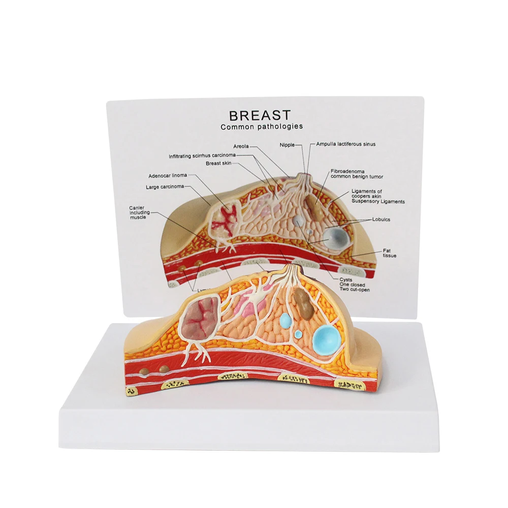 Gynecological Female Breast Anatomical Model Breast Pathological