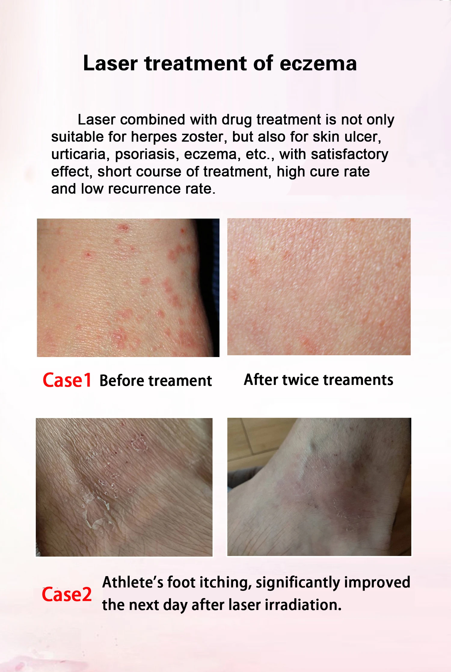 Fornecimento de fábrica de fisioterapia a laser 980 nm 810 nm para alívio da dor no ombro, joelho, redução da dor corporal, dispositivo de laser de diodo