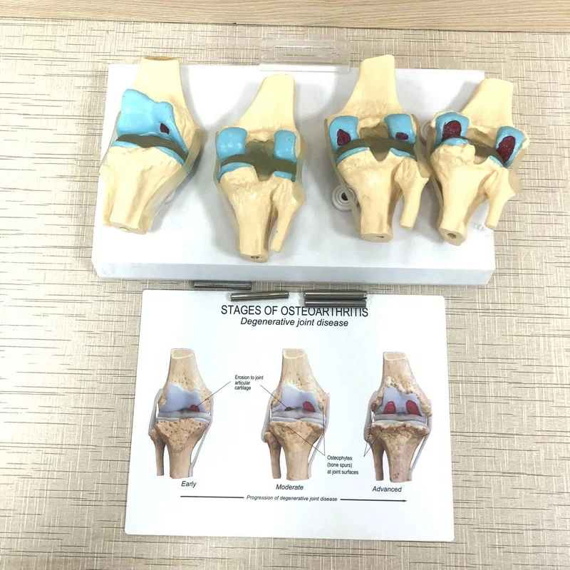 Высококачественная медицинская модель анатомии человека, этапы остеоартрита