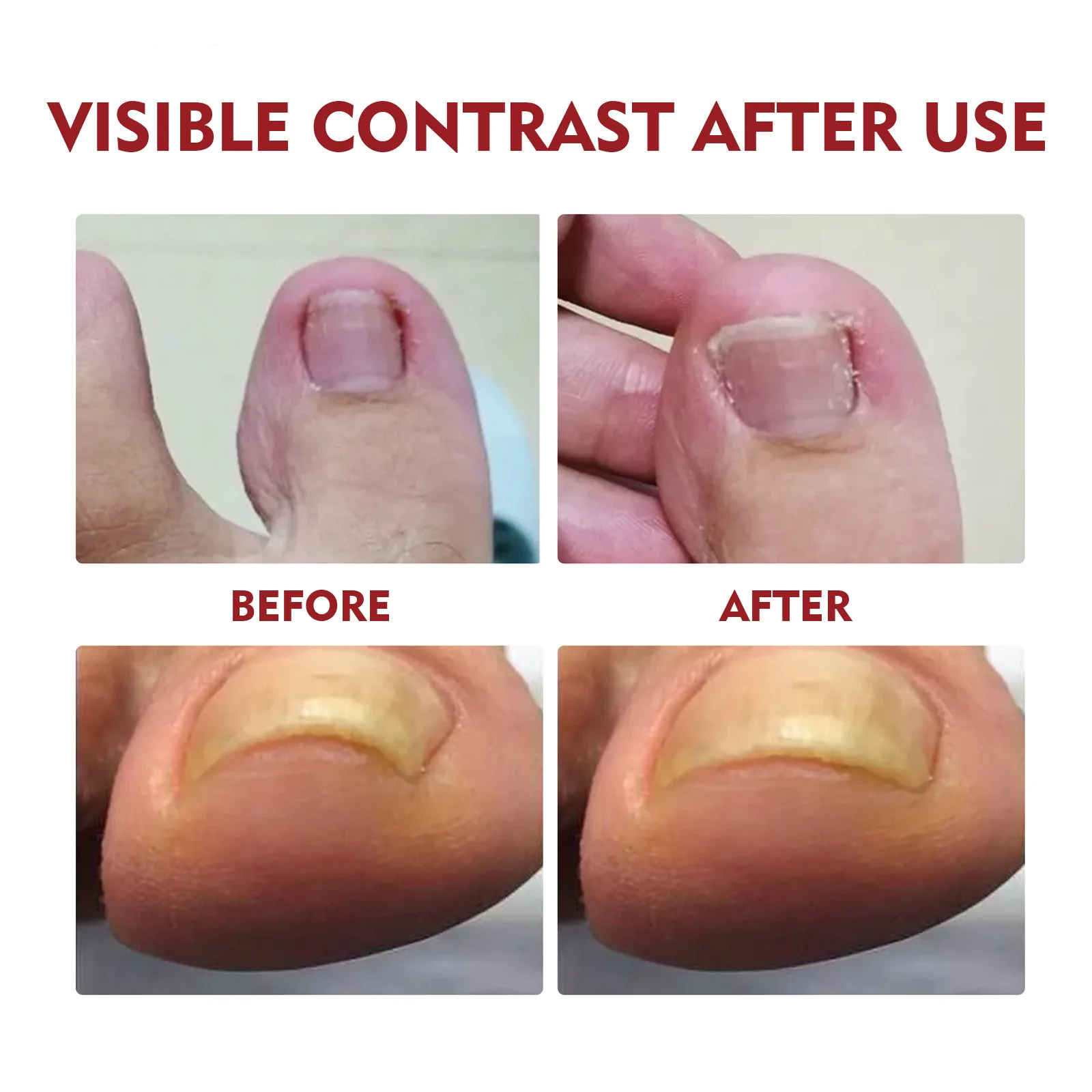 Nail Renewal Extra Strength Fungus Toe Fingernails Repair Liquid Renew Damaged Broken Nail 7 Days Nail Fungus Treatment