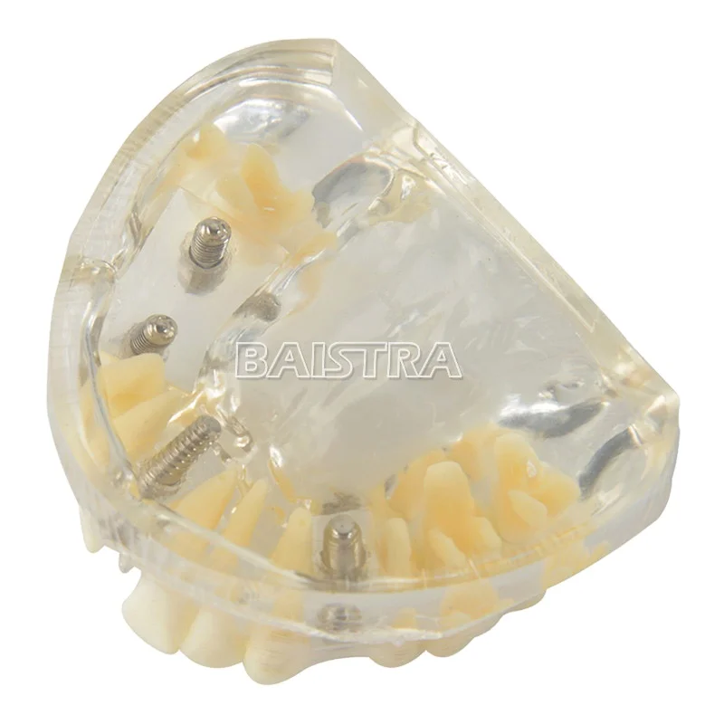 Широко используются пластиковые 4 гвоздя импланты модель зубов Модель