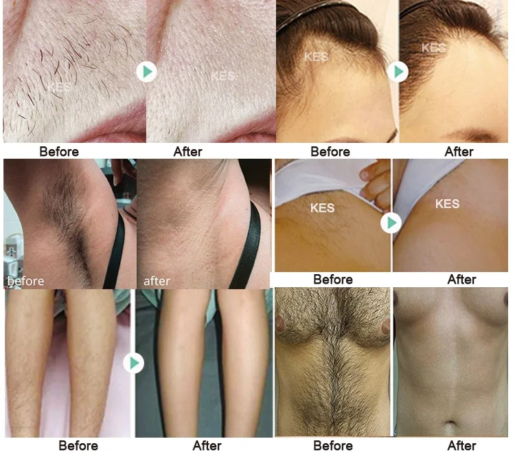 Ce Approved New Generation 3 Waves Portable 755nm 808nm 1064nm Portable Diode Laser Hair Removal Machine