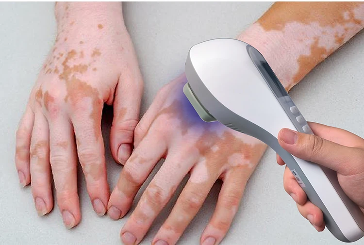 UVB Light Therapy Device for Vitiligo
