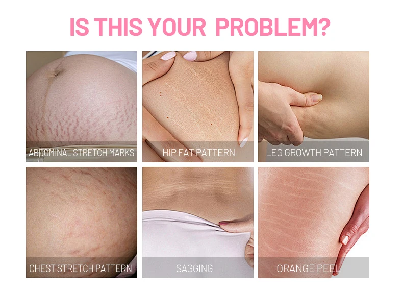 Aichun Beauty Best Anti-Stretch Mark Body Oil Strech Marks Removed and Firming Essential Oil Preventing Reducing Stretch Marks