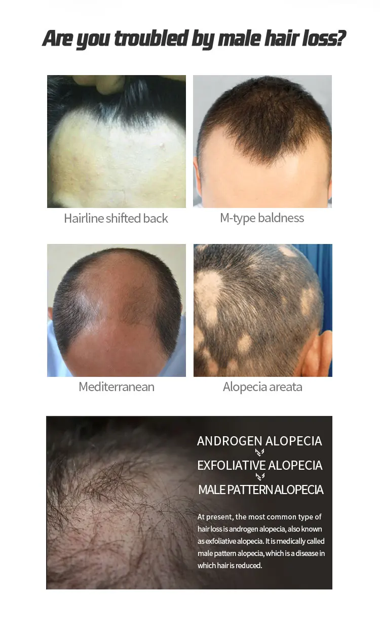 Men's Topical Solution Anti- Hair Loss Treatment Hair Regrowth Oil Biotin Hair  Growth Serum For Thinning Bald Area For Men - Buy Hair Regrowth Foam,Hair  Foam,Hair Loss Treatment Product on 