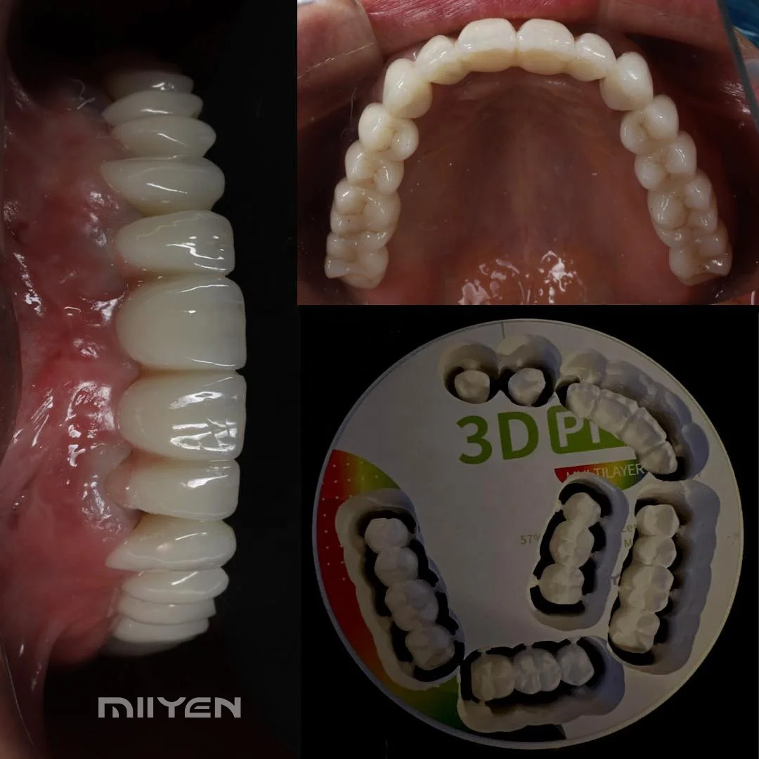 Miiyen Digital St 1400mpa Posterior Teeth Dental Cad Cam Zirconia ...