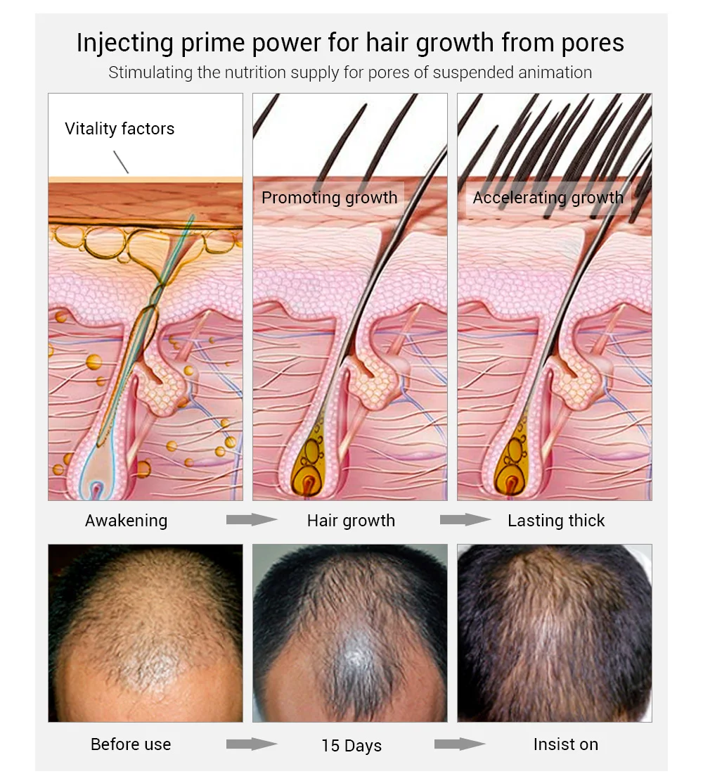Lanbena Hair Regrowth Treatment Serum Thailand Hair Regrowth Tonics ...