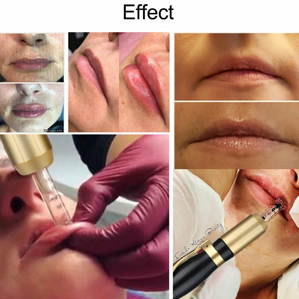 Как увеличить губы инъекции