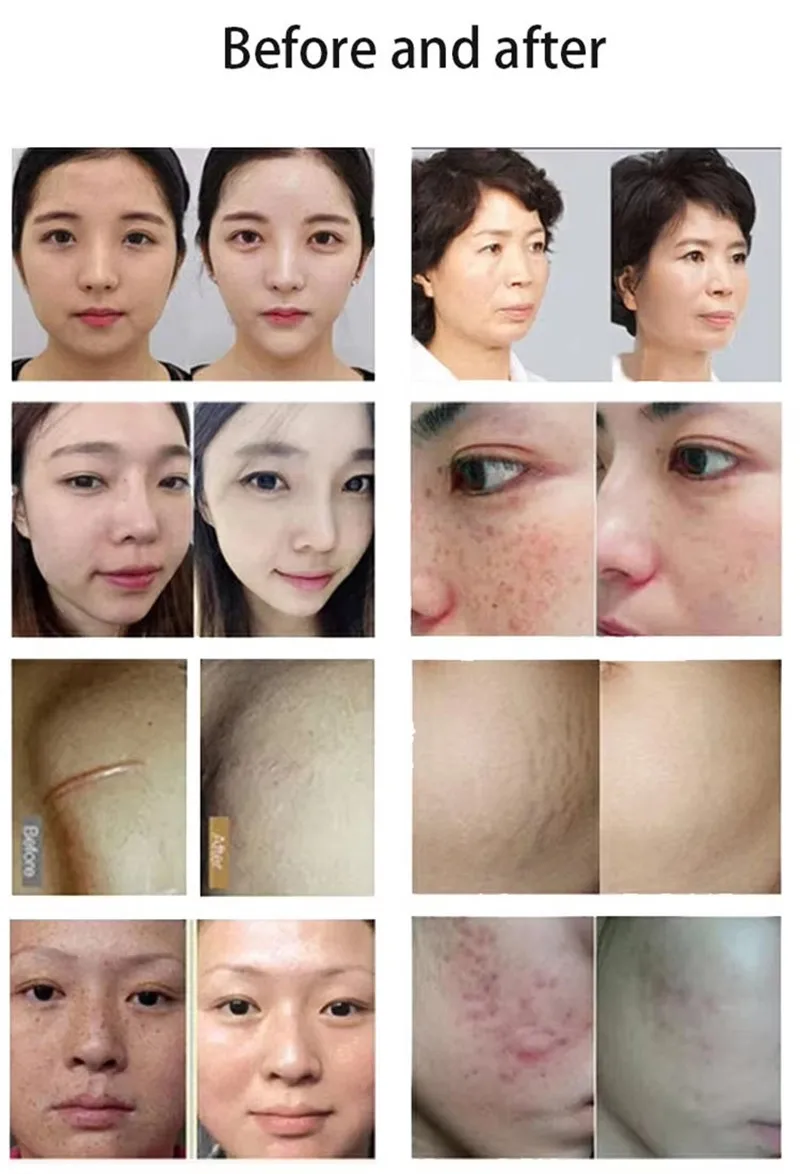 Crystallite Depth M8 Microneedle RF Acne Treatment Machine Depth 8 RF Machine Price in 2024