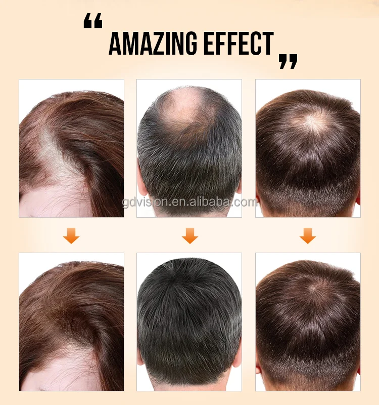 Results Guaranty In 30 Days Men Hair Loss Treatment Biotin Hair Growth  Serum Oil - Buy Biotin Hair Growth Serum,Hair Loss Serum,Hair Loss  Treatment For Men Product on 