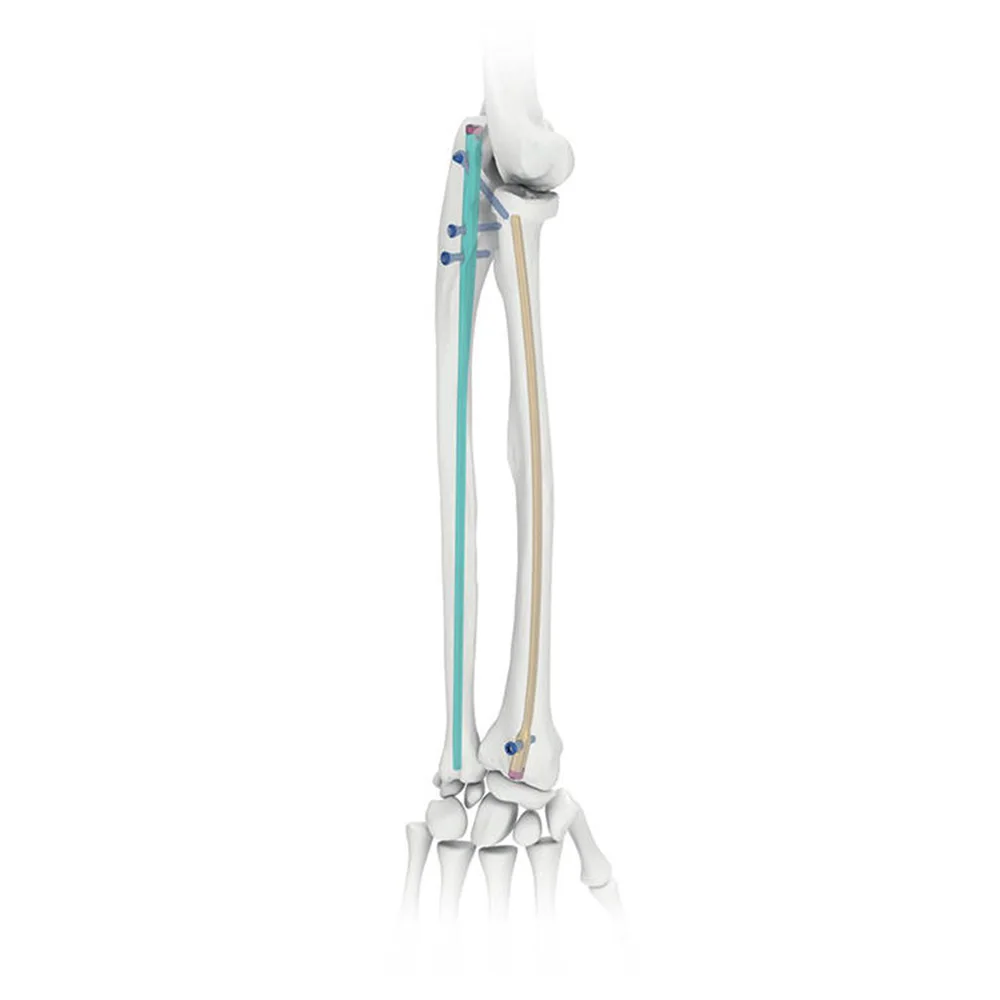 Radius & Ulna Nail