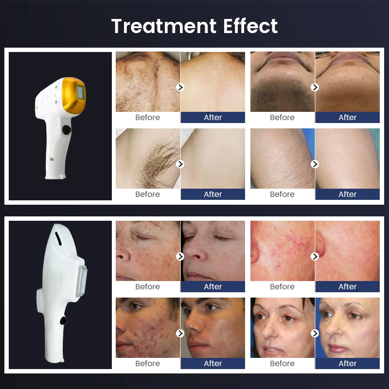 Diode Laser Hair Removal Ipl Opt Nd Yag Multifunctional 2 In 1 Beauty