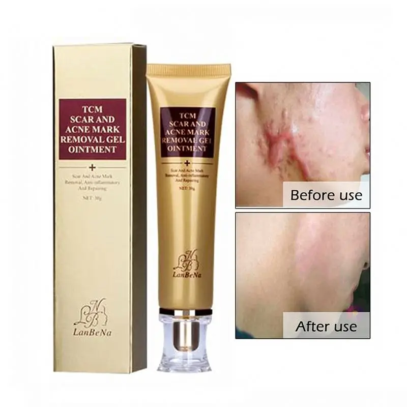 pimple spot removal cream