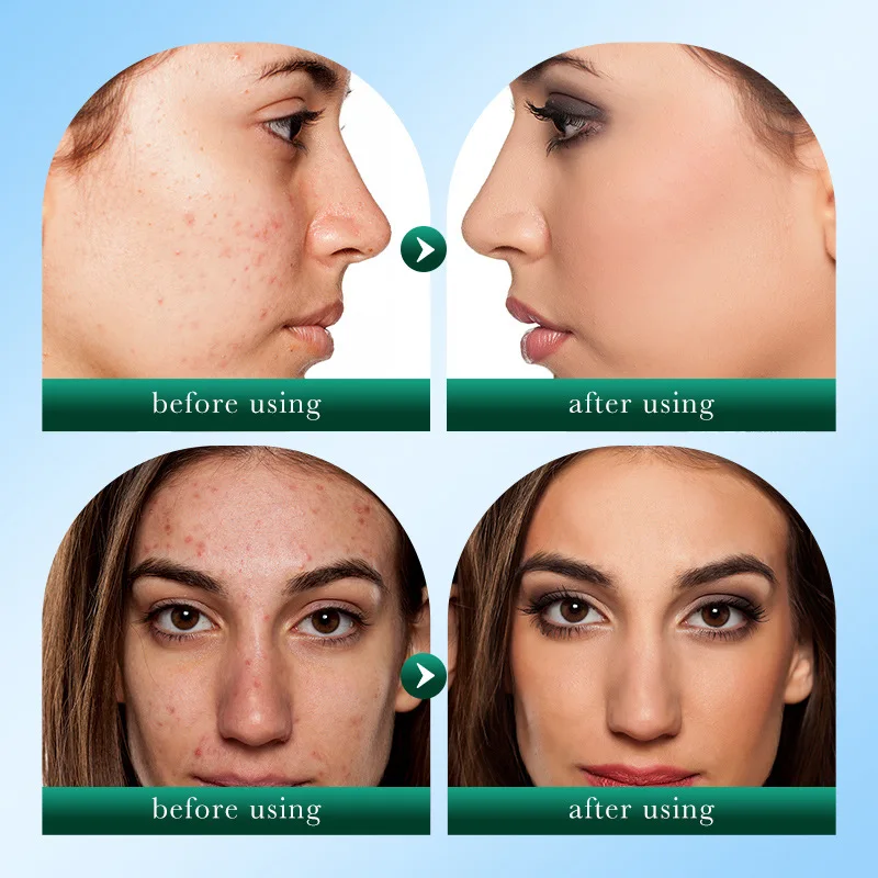 New Arrival SADOER Tea Tree Acne Removing and Oil Control Facial Cleanser