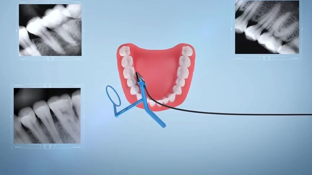 Affordable Dental Xray Sensor Rvg Digital Intraoral Imaging System X