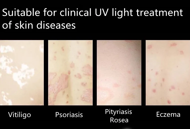 UVB Light Therapy Device for Vitiligo