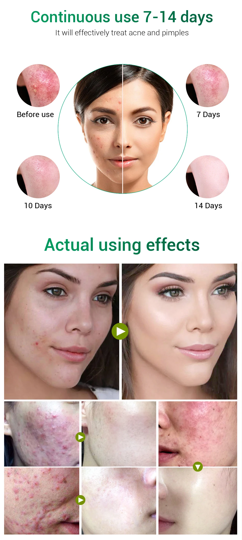 BREYLEE Private Label Tea Tree Oil Dark Spot Removing Acne Pimple Skin Repair Face Cream supplier
