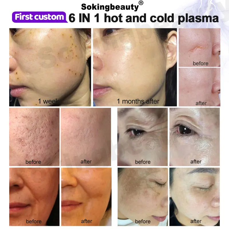 New Design Output Power 150w 16 Tips Face Lifting Firming Hyper Scalp Plasma 6 in 1 Hot and Cold Plasma Machine