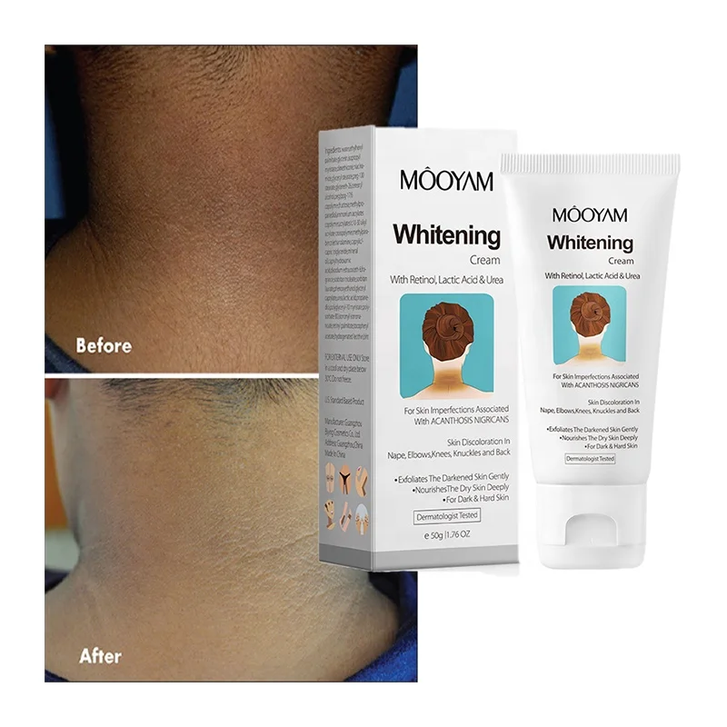 Organic Acanthosis Nigricans Treatment Cream Whitening Cream For Remove Black Patches Knee Elbow Neck Underarm Buy Whitening Cream Acanthosis Nigricans Treatment Underarm Whitening Cream Product on