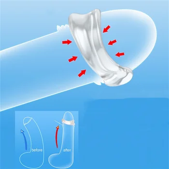 Penis Rings 2PCS Male Foreskin Correction Cock Rings Chastity Cage Training Device Delay Ejaculation Sex Toys for Men Couple