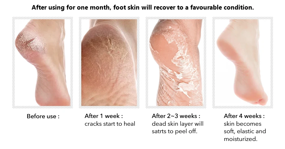 private label foot peal mask