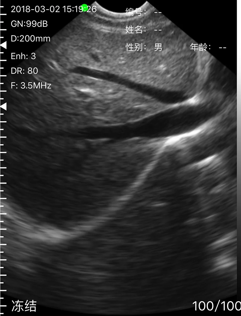 SURESULT D2LM Linear Micro Convex Transductor De Ultrasonido De Matriz Lineal De Alta Frecuencia Color Doppler