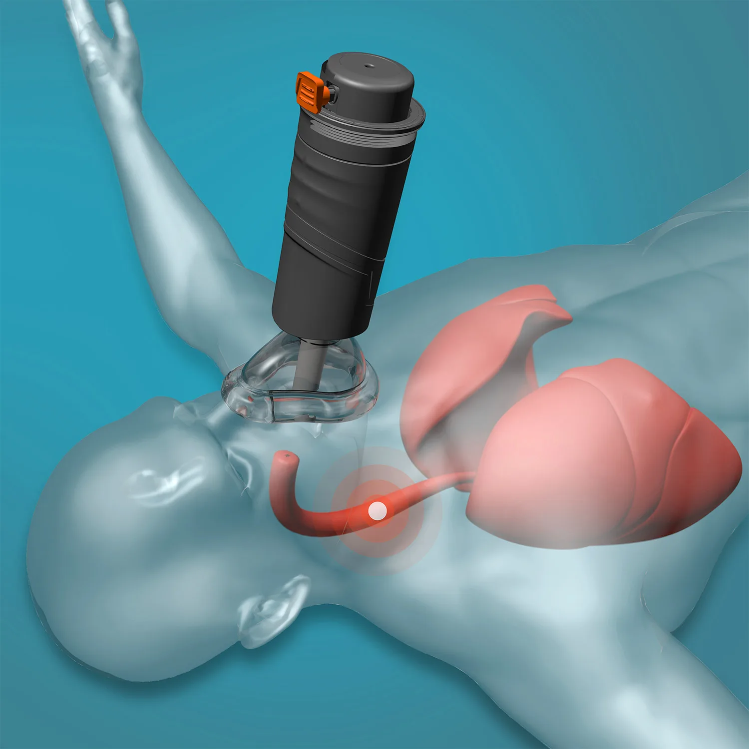 Sonmol Automatic Choking Rescue Anti Choking Device Aiway Throat Obstruction Blockage Removal Manual Suction Emergency