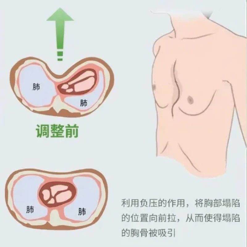 Medical Chest Brace for Pectus Excavatum Negative Pressure Suction Cup Parts Artificial Interventional Material