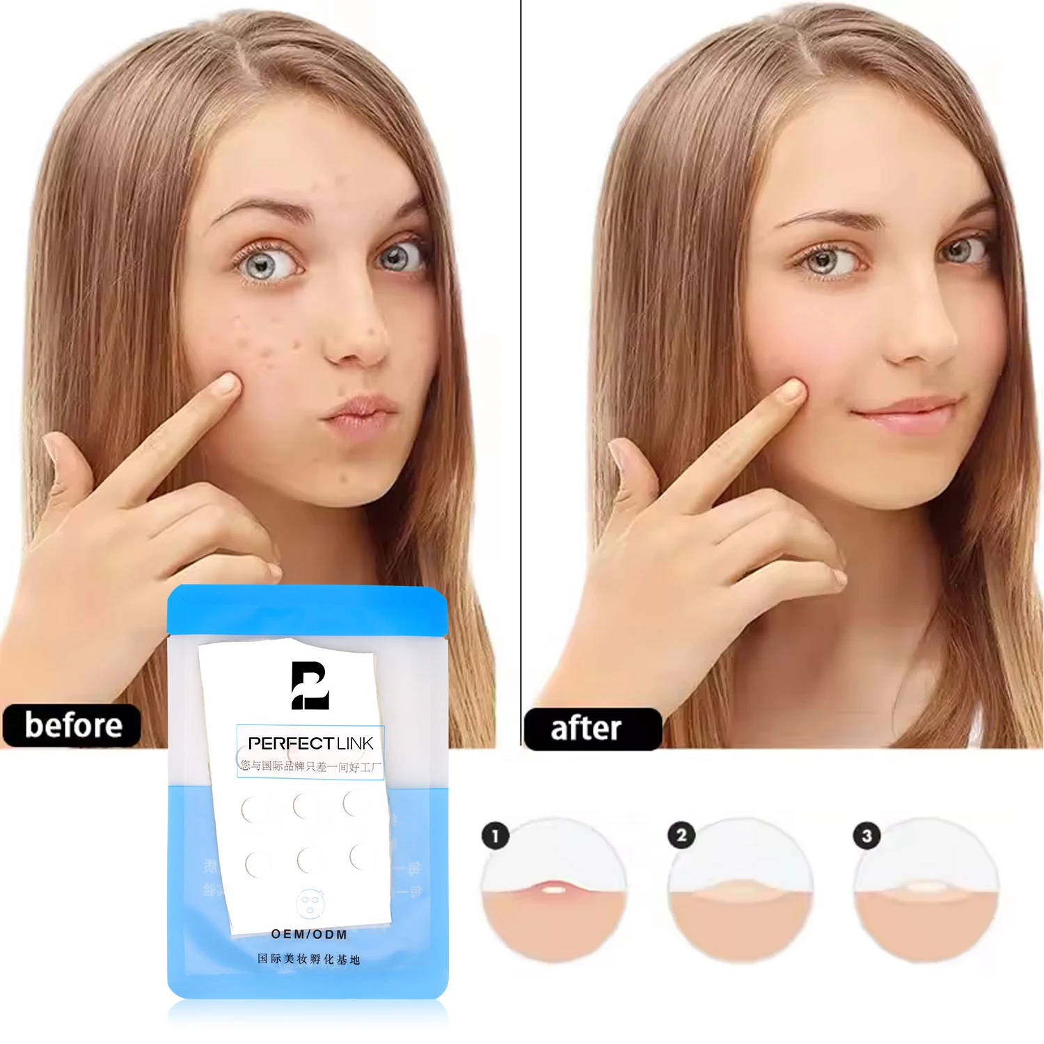 16pcs Perfectcare China Water-soluble Acne Pimple Master Patch OEM ...