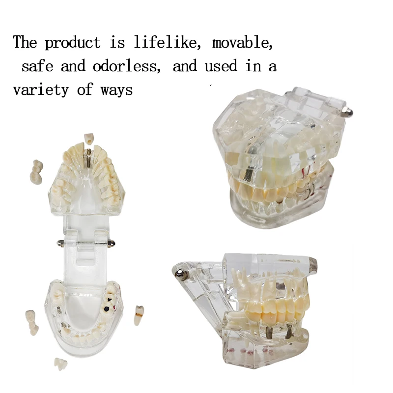 Прозрачная модель зубов для коррекции полости рта съемный имплантат дисплей ногтей обучающая