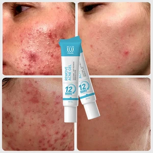 Best Spot Face and Dark Spots to Dry Out That Dries Pimple Women Get Rid of Scars Creams Drying Cream for Pimples