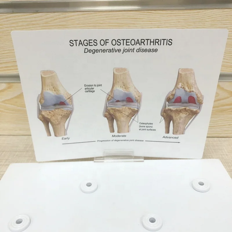 Высококачественная медицинская модель анатомии человека, этапы остеоартрита