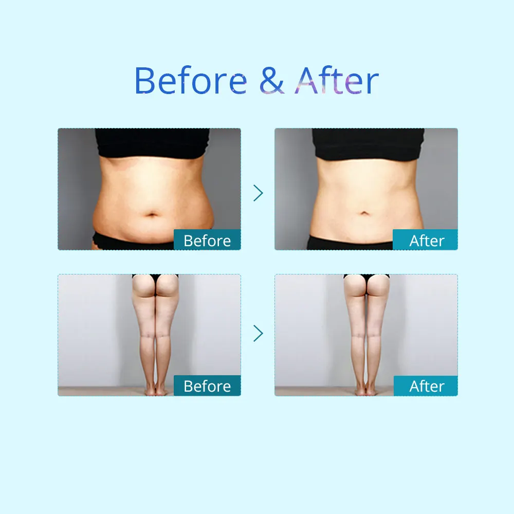 WL 7008C 2 Handles Cryo Slimming Cellulite Reduction Cooling Sculpting Machines Fat Freezing