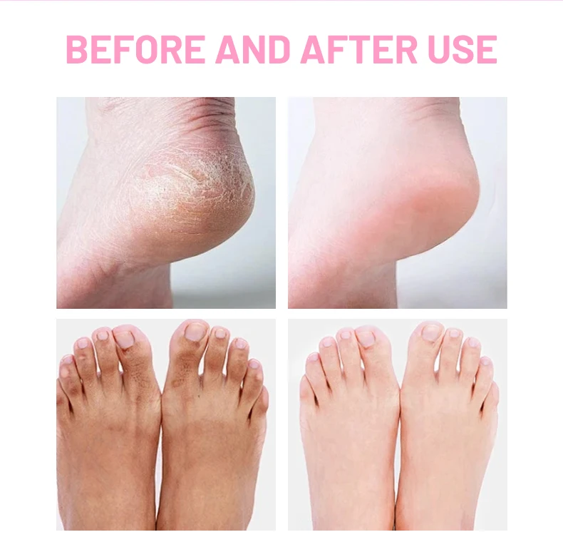 Wholesale Coconut & Vitamin E Peeling Foot Mask Sock with Hyaluronic Acid for Moisturize Smooth Repair and Soften Cracked Heels