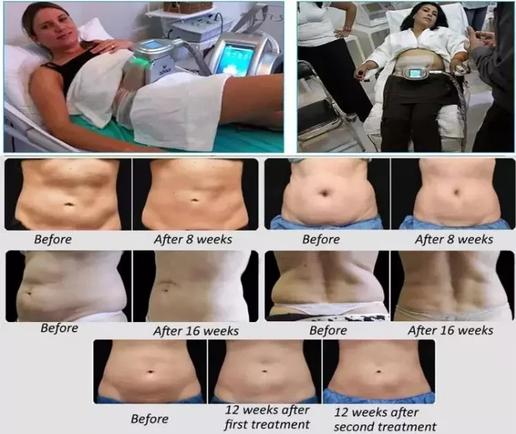 Membrane 360 Cryolipolysis Vacuum Machine Cool Tech Fat Freeze Home Use Slimming