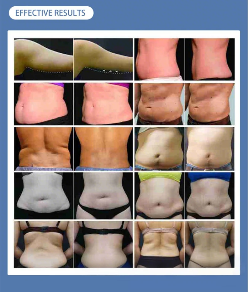 8 Pads Cryo Lipolysis Cryotherapy Fat Freezing Body Sculpting Machine 9 Discover the professional 8 Pads Cryo Lipolysis Cryotherapy Machine for non-invasive fat freezing, body sculpting, slimming, and advanced cryotherapy contouring treatments for salons and med spas. 8 Pads Cryo Lipolysis Cryotherapy Fat Freezing Body Sculpting Machine