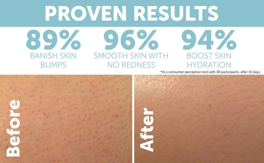 Strawberry Legs Kp Ingrown Hair Treatment Bumpy Skin Body Lotion