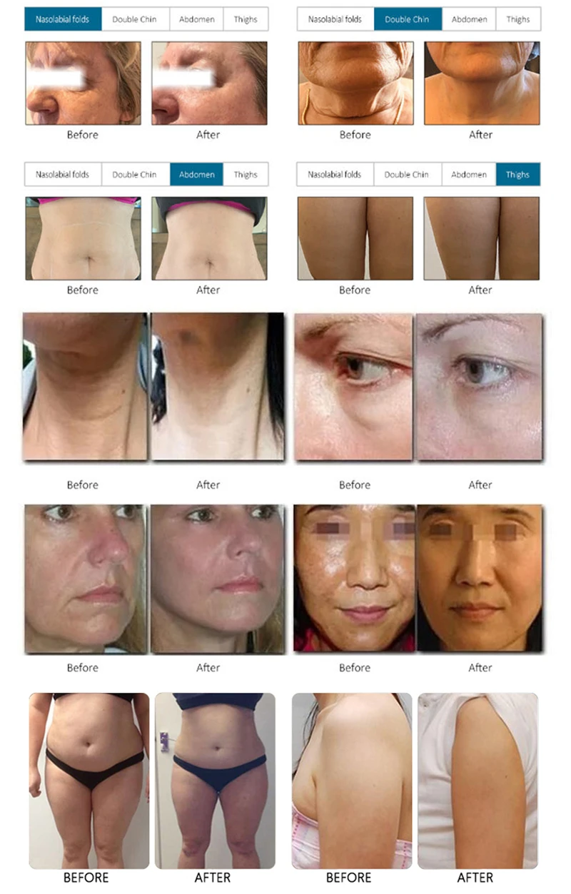 2024 professional anti aging anti-wrinkle machine Face Lift face firming Wrinkle Remover smas mfu rf skin beauty salon machine